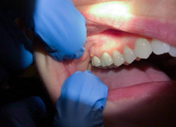 Best Emergency Treatment for Dental Infections or Abscesses in Moorefield, WV